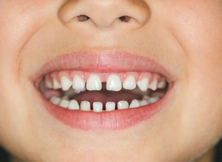 Зубы в 5 рядов. Рвные зубы после брекит. Частичная брекет-система 2x4. Красивые брекеты для детей. Скученность зубного ряда.
