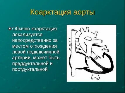 Гемодинамика коарктация