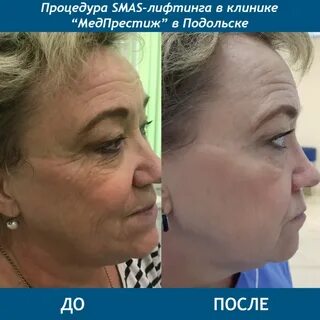 Смас лифтинг сколько процедур нужно