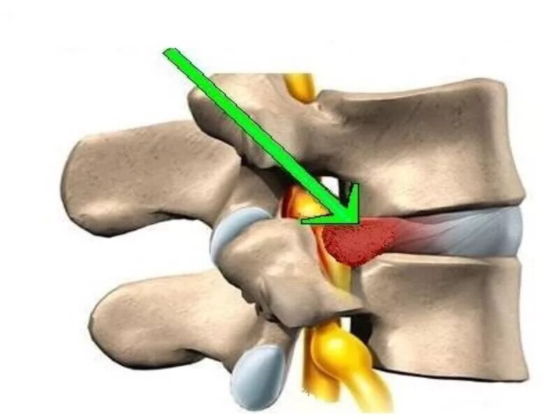 Межпозвонковая грыжа поясничного отдела лечение. Межпозвоночная грыжа поясничного отдела. Грыжа диска l5-s1. Диск l5-s1. Грыжа межпозвоночного диска позвоночника.