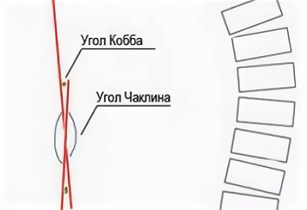 Угол коба. Измерение угла сколиоза по чаклину. Угол коба. Измерение угла сколиоза по чаклину. Сколиоз позвоночника по методу кобба.