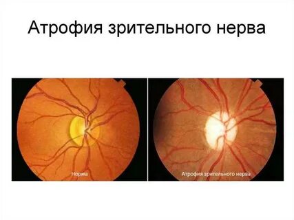 Капли атрофии зрительного нерва