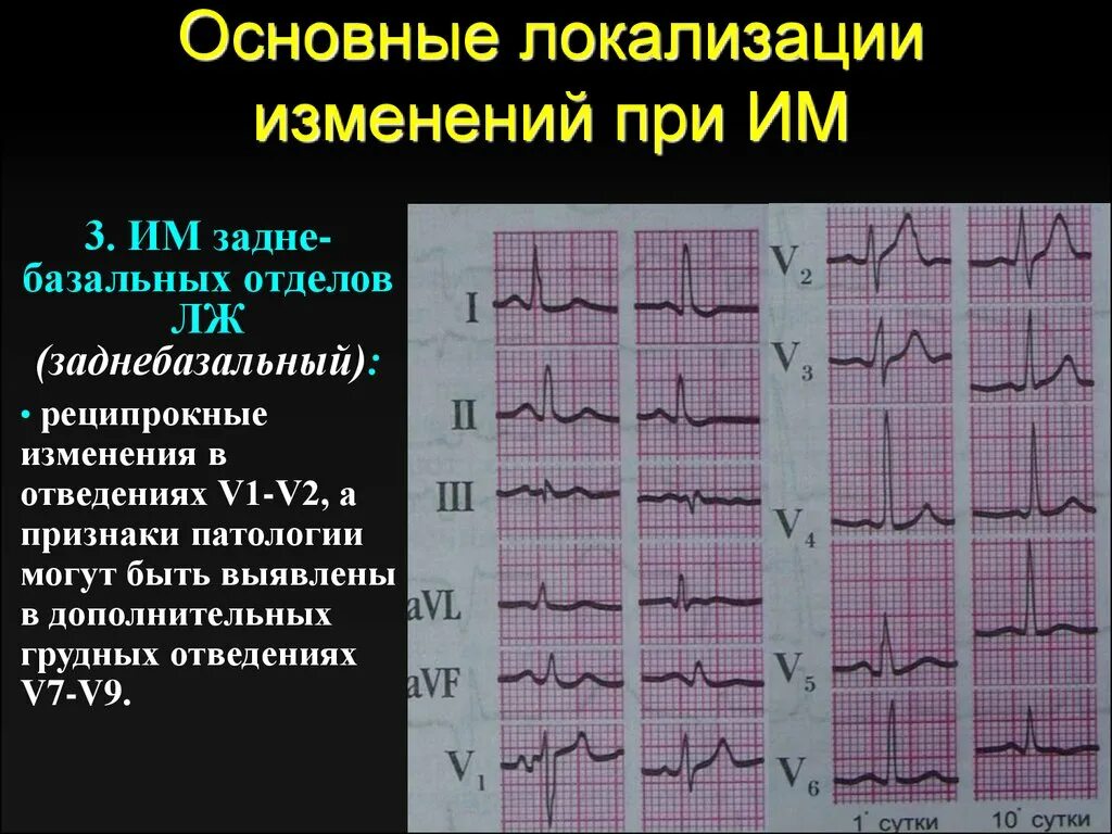 Инфаркт миокарда ЭКГ грудные отведения. Аномалия St-t на ЭКГ. Заднедиафрагмальный инфаркт миокарда ЭКГ. ЭКГ при заднебазальном инфаркте.