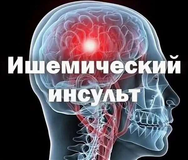 Инсульт правая сторона тела. Инсульт левого полушария. Инсульт левая сторона. Инсульт левой стороны головного мозга. Инсульт головного мозга левая сторона 74мм.