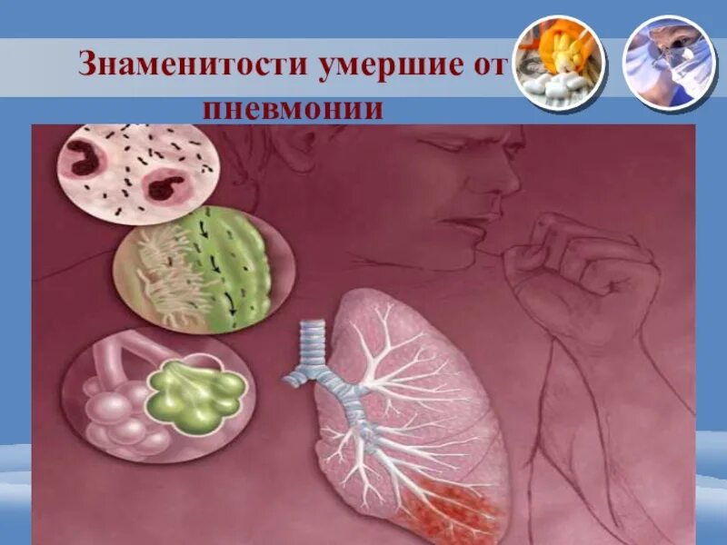 Через сколько умирают от пневмонии. Осложнения пневмонии.
