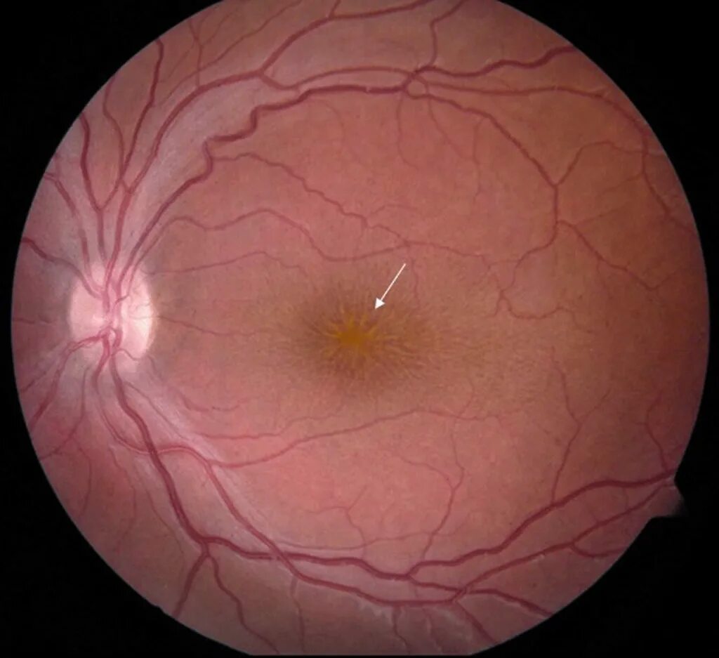 Ретиношизис дистрофия сетчатки. Макулярный ретиношизис. Артифакия, ретиношизис. Ювенильный ретиношизис.