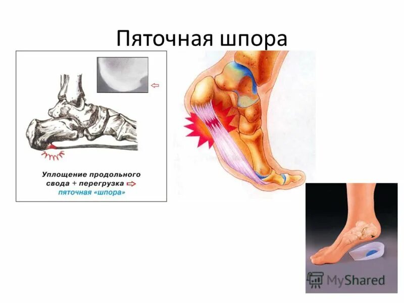 Шпора на пятке симптомы у мужчин. Анатомия пяточной шпоры. Верхние пяточные шпоры.