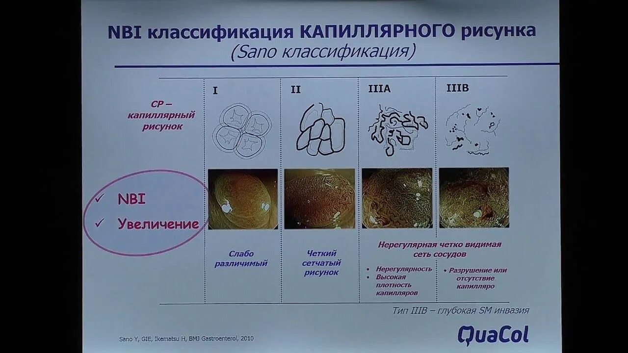 Nice классификация полипов толстой кишки. Эндоэксперт классификации. Классификация эпителиальных новообразований толстой кишки. Эндоэксперт. Эндоэксперт классификации.