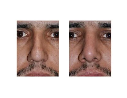 Nose am