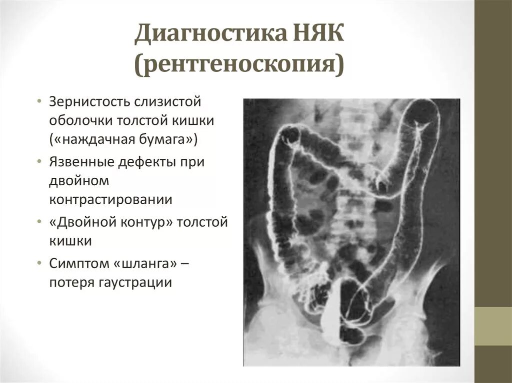 Стеноз кишечника что это. Хронический колит кишечника на рентгене. Няк толстой кишки рентген. Неспецифический язвенный колит рентгенодиагностика. Язвенный колит на рентгенограмме.