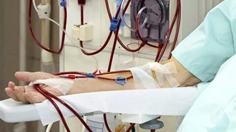 Гемодиализ раз в неделю