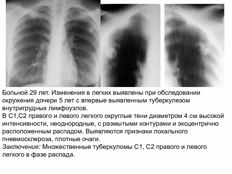 Что означает изменение в легких