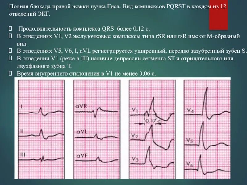 Комплекс блокада. Блокада правой ножки пучка Гиса на ЭКГ отведения. 2 Отведение ЭКГ блокада ножки пучка Гиса. ЭКГ при блокаде Гиса правой ножки. Блокада правой ножки пучка Гиса на ЭКГ.