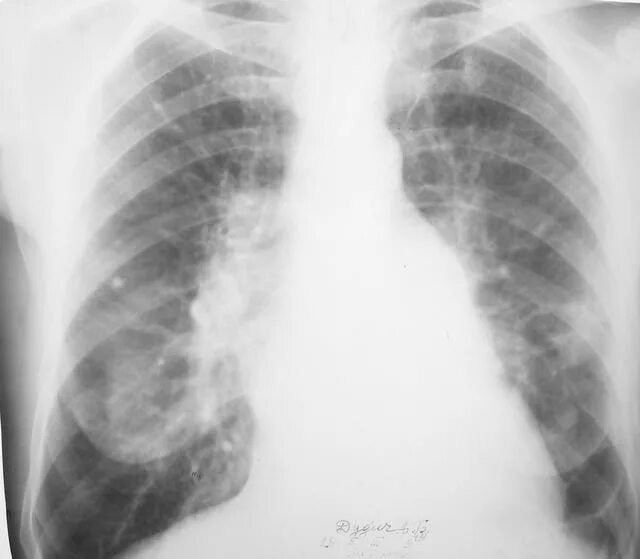 Патология корня легкого рентген. Патологии корня лёгких на рентгене. Синдром патологии корня легкого на рентгенограмме.