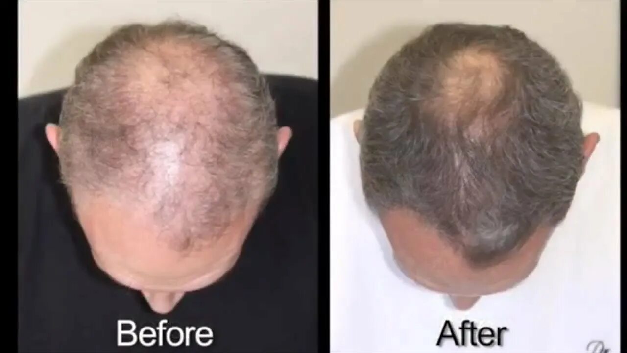 Мелатонин при алопеции. Мелатонин 5 htp. Мелатонин для детей для сна. Мелатонин 10 мг iherb. Natrol liquid melatonin жидкий.