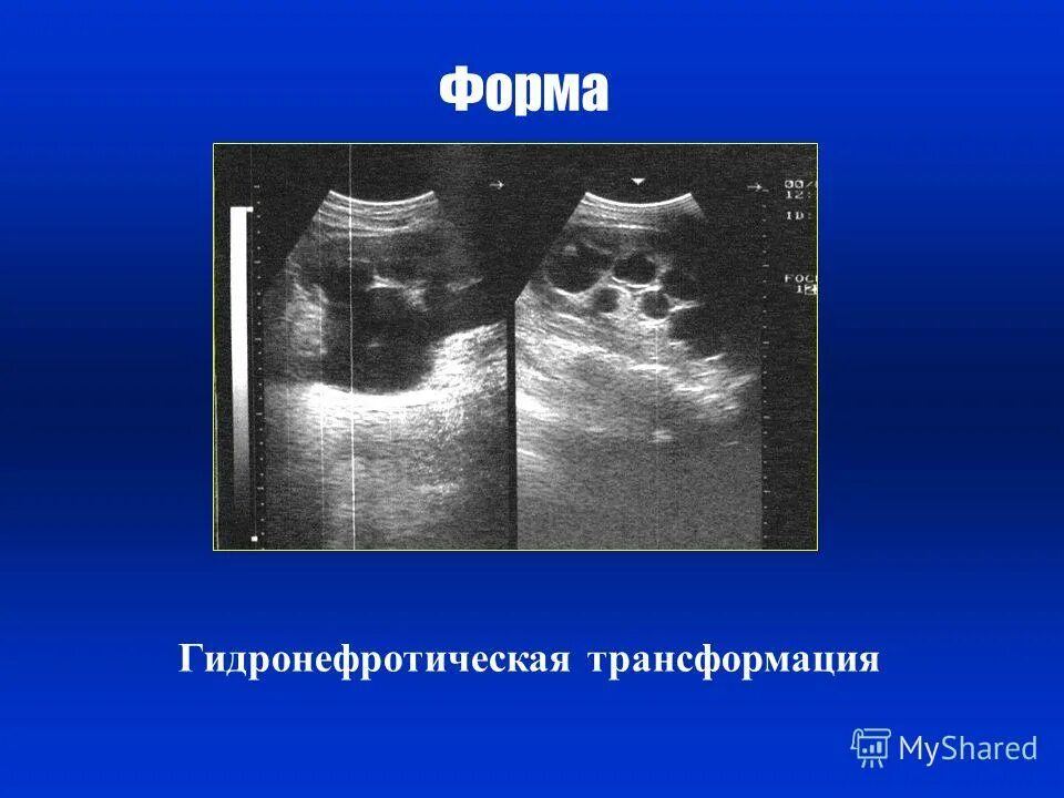 Гидронефроз 1 стадии узи. Гидронефротическая трансформация левой почки. Гидронефротическая трансформация на кт. Гидронефроз почки 3 стадии. Гидронефротическая трансформация почки.