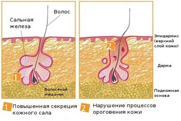 Выработка сальных желез