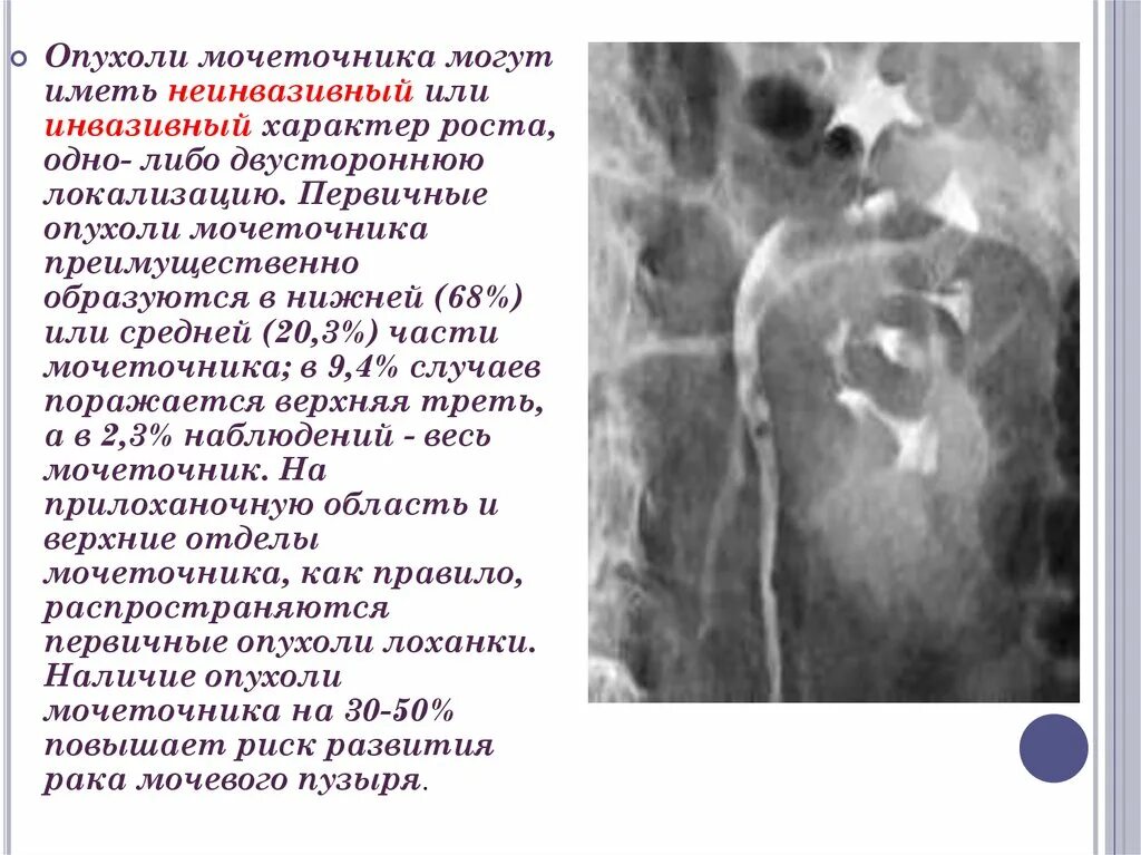 Анализ мочеточника. Папиллярная опухоль мочеточника. Опухоль нижней трети мочеточника. Новообразование мочеточника. Опухоль мочеточника рентген.