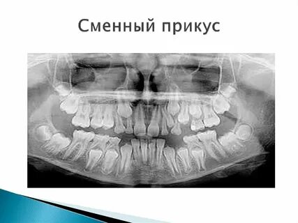 Постоянный прикус