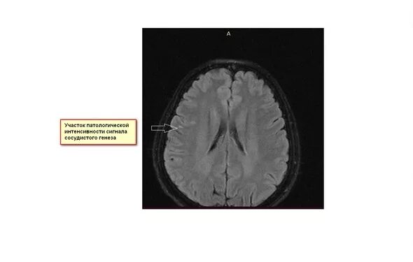 Сосудистый очаг в головном мозге что это. Кортикальный глиоз. Очаги глиоза в белом веществе головного мозга на мрт. Лейкоэнцефалопатия головного мозга мрт. Глиоз в головном мозге на мрт.