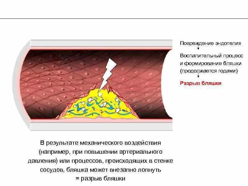 Повреждение эндотелия. Повреждение эндотелия сосудов. Причины повреждения эндотелия сосудов. Процесс развития атеросклероза повреждение эндотелия.