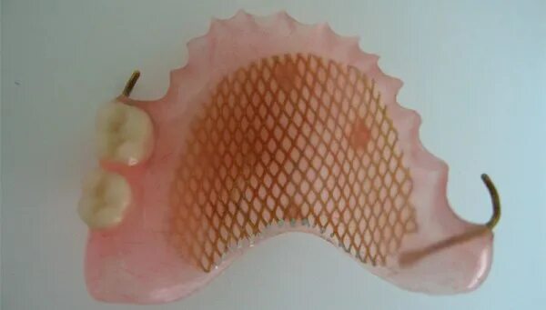 Армирование съемного протеза. Армированный базис съемного протеза. Протез с металлическим базисом. Армирование съемного протеза. Пластиночный протез с металлическим базисом.