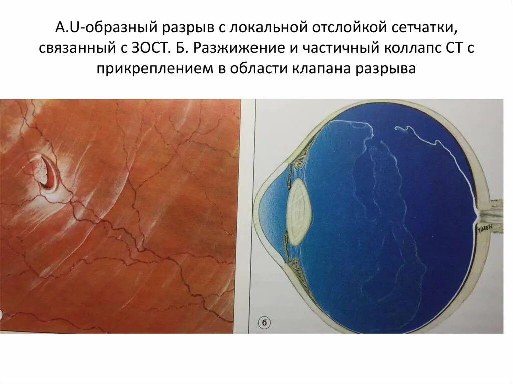 Периферическая отслойка сетчатки. Отслойка сетчатки этиопатогенез. Периметрия отслойка сетчатки. Локальная отслойка сетчатки. Повреждение сетчатки