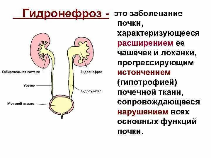 Почки лоханка причины. Гидронефроз левой почки 2ст. Лоханка смешанного типа почки у взрослого. Норма строения почек лоханки у детей. Лоханка почки 13мм.