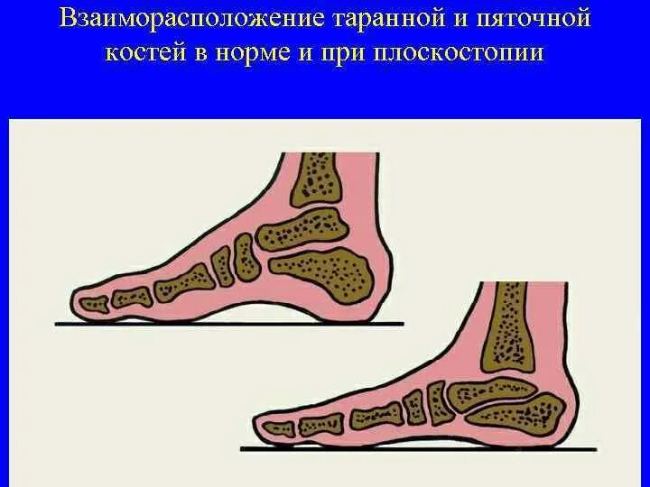 Плоскостопие. Вывод на тему плоскостопие. Плоскостопие история болезни. Поперечное плоскостопие. Продольное и поперечное плоскостопие.