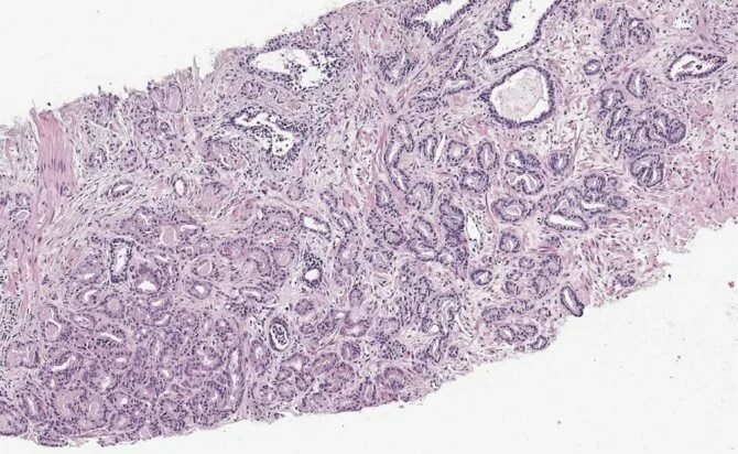 Ацинарная аденокарцинома гистология. Аденокарцинома Глисон 3+4. Ацинарная аденокарцинома предстательной железы гистология. Аденокарцинома Глисон 6 (3+3). Ацинарная аденокарцинома предстательной железы глисон 7