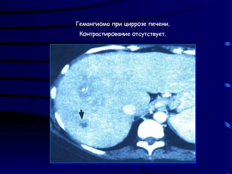 Атипичная гемангиома печени на кт. Лакунарная гемангиома печени. Кавернозная гемангиома печени кт. Кавернозная гемангиома печени мрт. Гемангиома печени причины и лечение