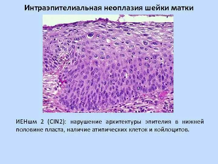 Дисплазия эпителия гистология. Дисплазия плоского эпителия гистология. Койлоциты дисплазия шейки матки гистология. Интраэпителиальная дисплазия.
