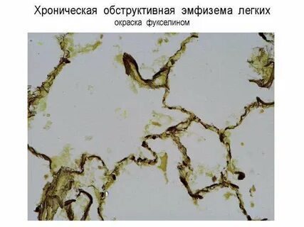 Хроническая эмфизема легких