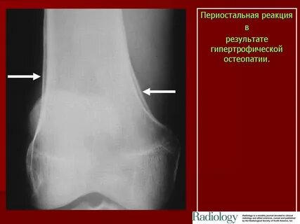 Периостальная реакция
