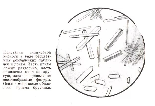 Иглы в моче. Кристаллы гиппуровой кислоты в моче. Микроскопия мочи соли мочевой кислоты. Гиппуровая кислота в моче под микроскопом. Микроскопия гиппуровая кислота в моче.