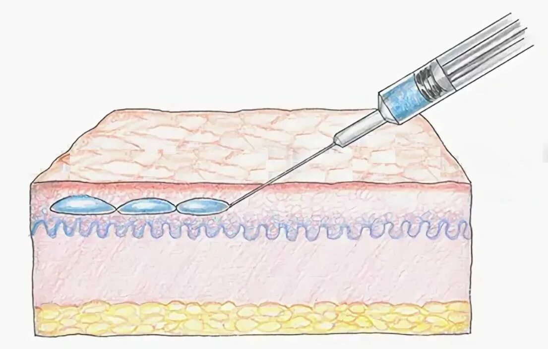 Как колоть филлер. Ретроградно линейная техника мезотерапии. Линейно-ретроградная техника введения филлеров. Линейно ретроградная техника в мезотерапии. Линейная ретроградная техника введения.