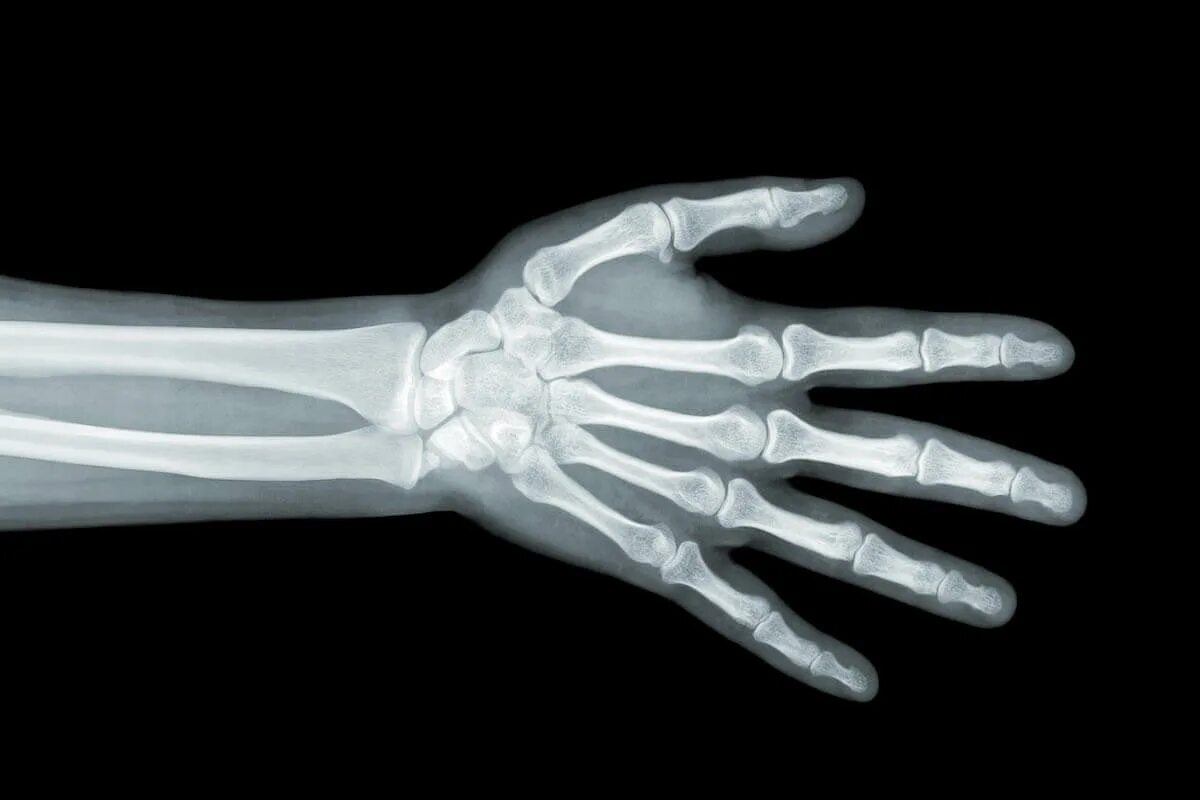 Рентген кисти норма. Рентген кисти правой руки норма. Лучезапястный сустав рентген здоровой руки. Рентгеновский снимок кисти. Xray extension