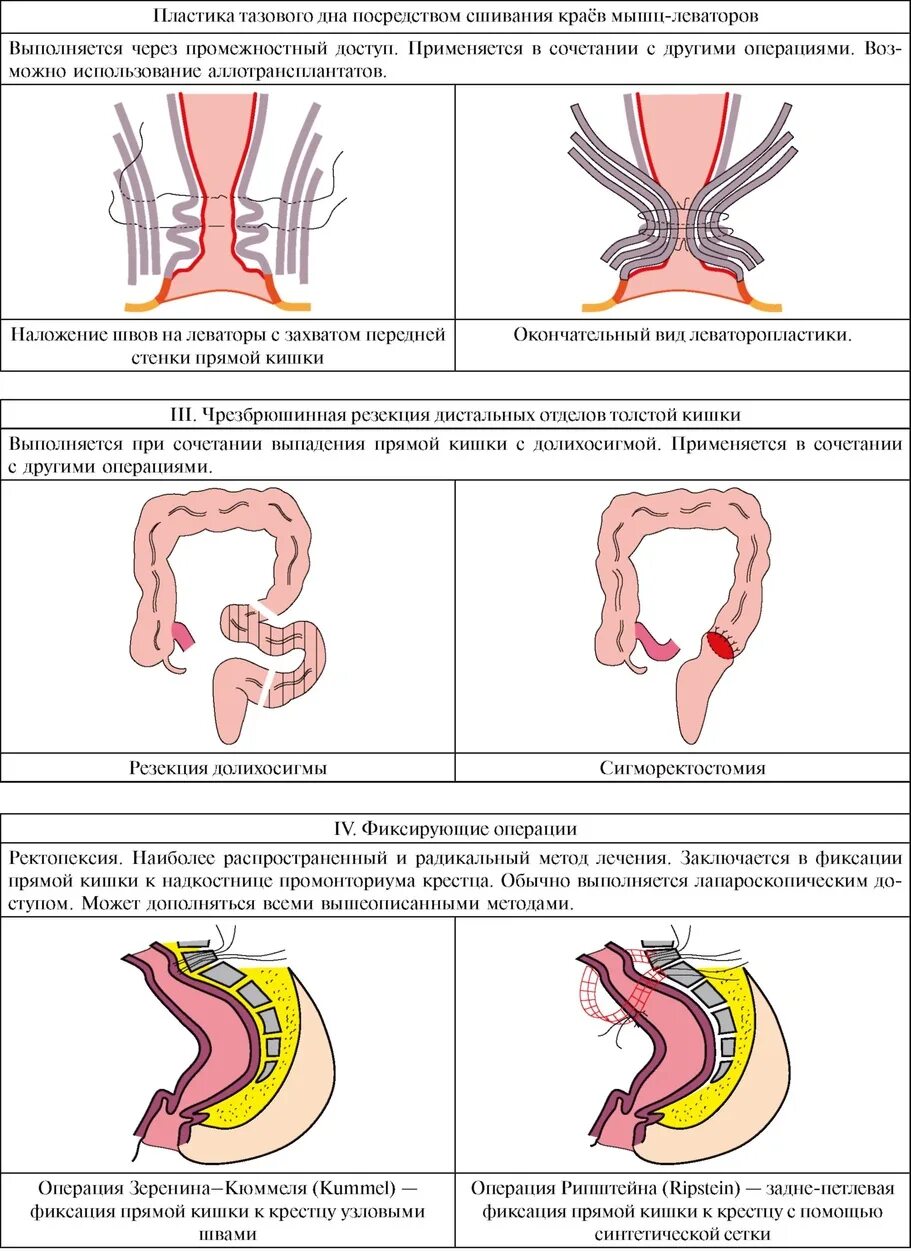 Выпадение прямой кишки тесты. Стадии выпадения прямой кишки. Неполное выпадение прямой кишки. Опускание прямой кишки.