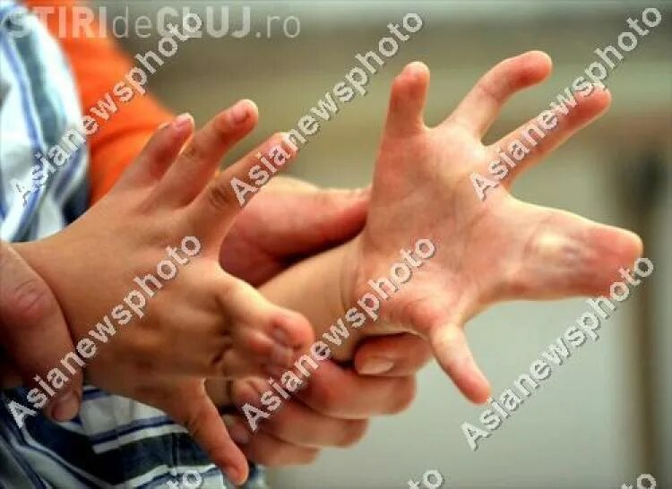 6 пальцев на руках у детей. Полидактилия многопалость.