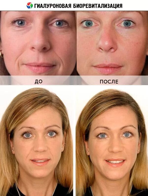 Уколы гиалуроновой кислоты в лицо. Гиалуронка инъекции для лица. Инъекции гиалуроновой кислоты до и после. Лицо до и после гиалуроновой кислоты.