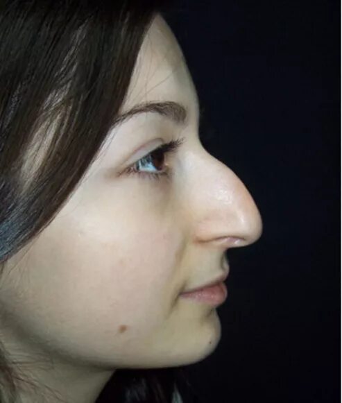 почему нос горбатый