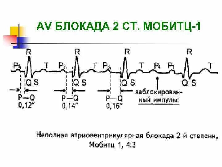 Атриовентрикулярная блокада 2. Блокада Мобитц 1 на ЭКГ. ЭКГ при АВ блокаде 2 степени Мобитц 1. ЭКГ атриовентрикулярная блокада Мобитц 2. Av блокада Мобитц 1 ЭКГ.