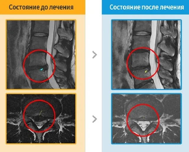 Поясничная грыжа лечение отзывы форум. Межпозвоночная грыжа мрт. мрт грыжи поясничного отдела позвоночника. грыжа диска поясничного отдела позвоночника мрт.