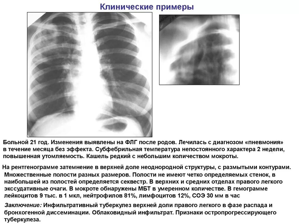 Очагово-инфильтративный туберкулез рентген. Инфильтративный туберкулез в фазе инфильтрации. Инфильтративный туберкулёз s1-2 левого. Изменения в верхней доле легкого