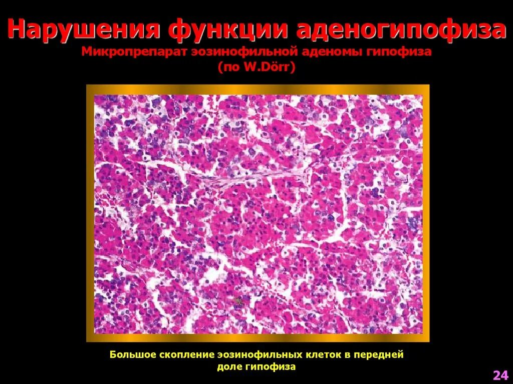 Хромофобная аденома гипофиза микропрепарат. Базофильная аденома. Гормонально активные аденомы гипофиза. Аденома гипофиза препарат патанатомия. Базофильная аденома гипофиза макропрепарат.