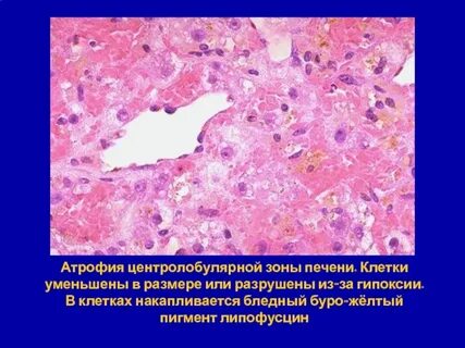 Бурая атрофия