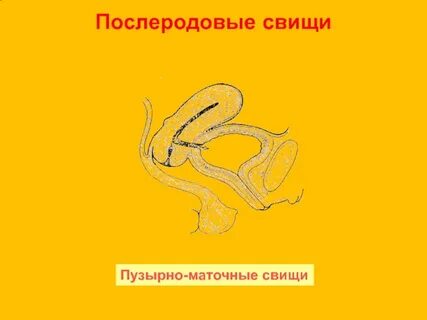 Влагалищный свищ