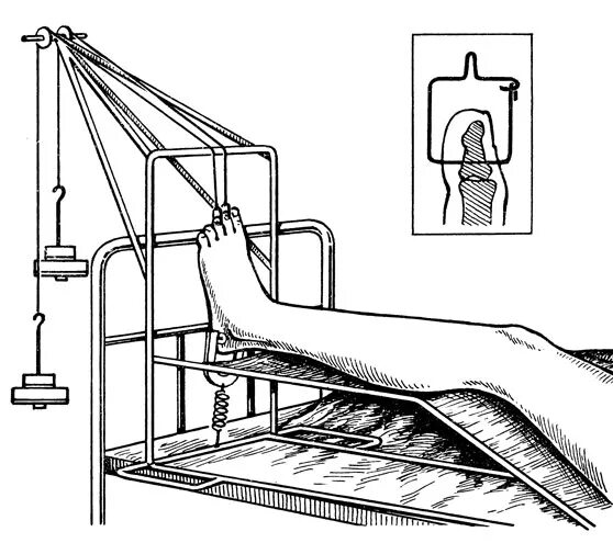 Скелетное вытяжение по юмашеву. Места проведения спиц для скелетного вытяжения. Перелом ноги с вытяжением. Скелетное вытяжение по каплану. Скелетное вытяжение при переломе большеберцовой кости.