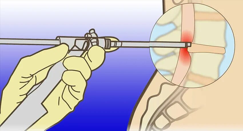 Эндоскопическая дискэктомия поясничного отдела позвоночника. Эндоскопическая фораминотомия. Эндоскопическая операция грыжи. Эндоскопическая операция грыжи позвоночника. Грыжа лазерная операция