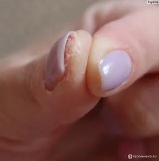 Аллергия на гель для ногтей